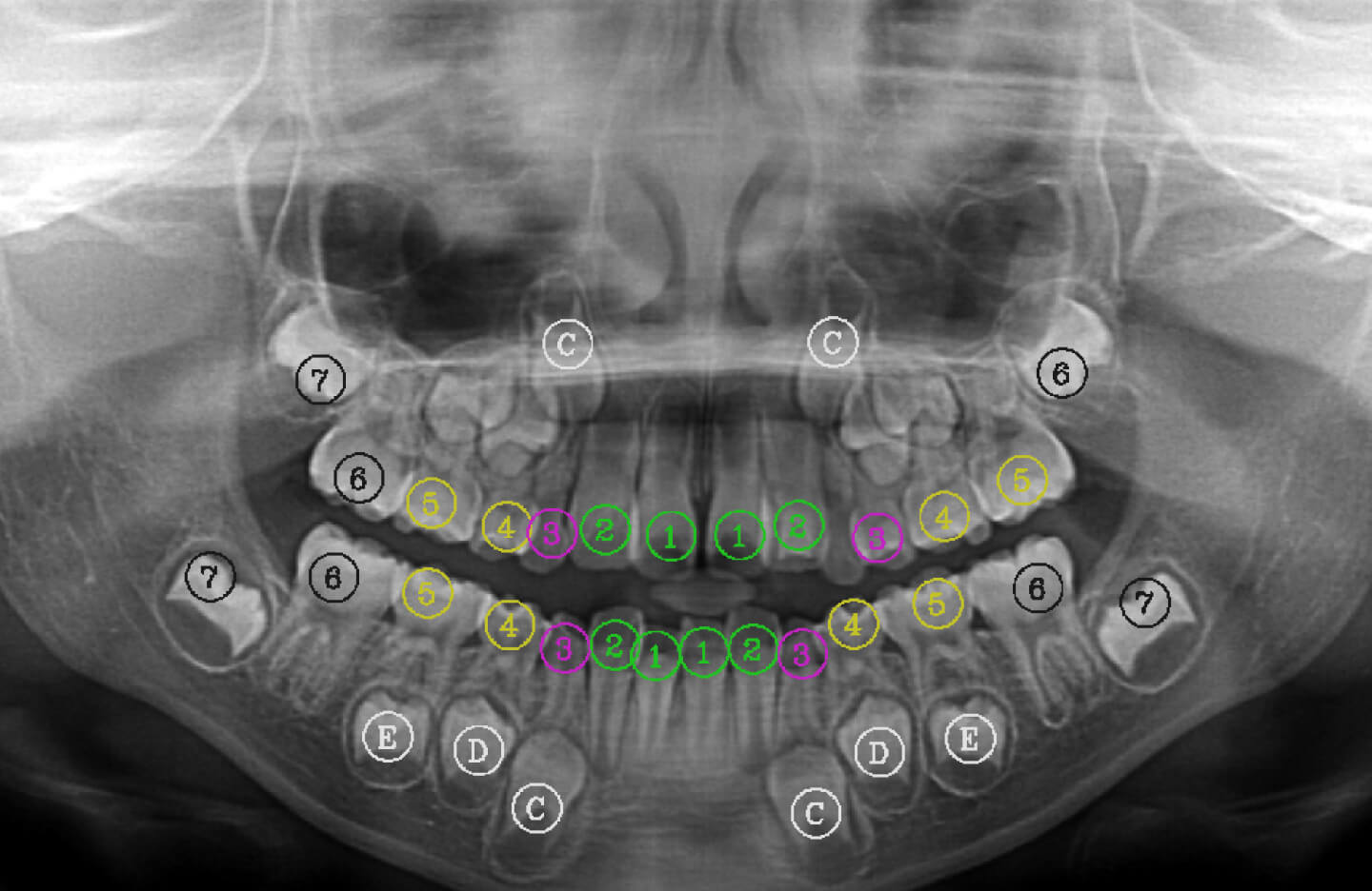 Dental x-ray result with the use of computer vision