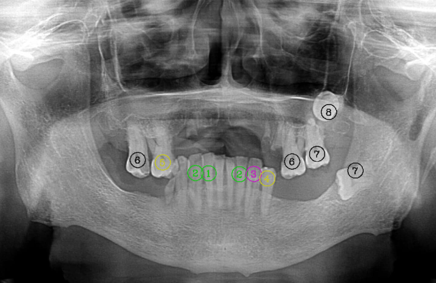 Computer vision AI used to detect teeth in xrays